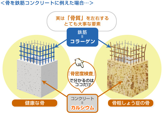 骨密度が高くても骨質（コラーゲンの質）が悪いと骨折のリスクが高まります。