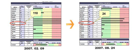 重金属検査を受け、慢性頭痛が水銀排出により改善