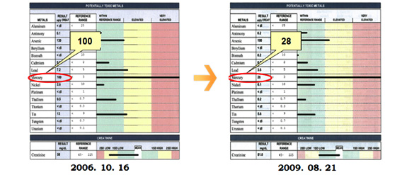 重金属検査を受け、肩こり・慢性疲労が水銀排出により改善